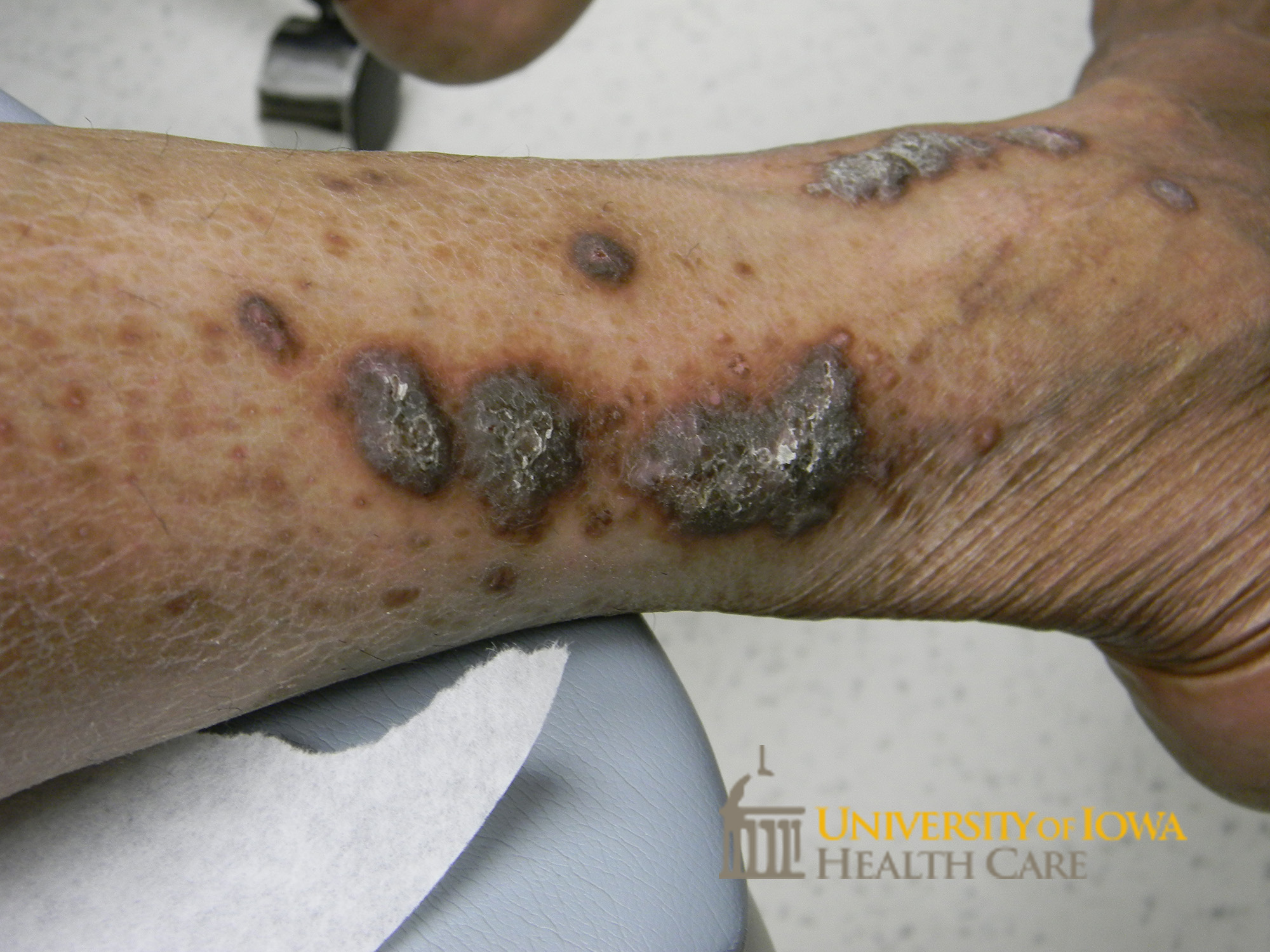Thick hyperpigmented to violaceous polygonal papules and plaques with scale on the lower extremity. (click images for higher resolution).